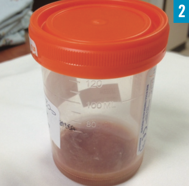 What Explains This Man’s Apparent Urine Discoloration? Consultant360